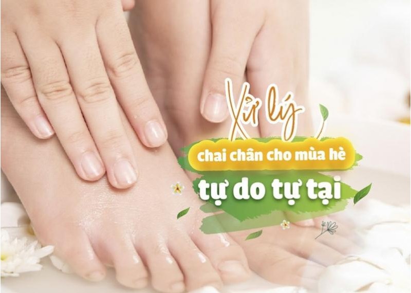 Xử lý chai chân cho mùa hè tự do tự tại